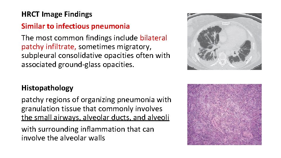 HRCT Image Findings Similar to infectious pneumonia The most common findings include bilateral patchy