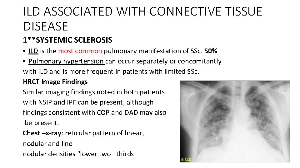 ILD ASSOCIATED WITH CONNECTIVE TISSUE DISEASE 1**SYSTEMIC SCLEROSIS • ILD is the most common