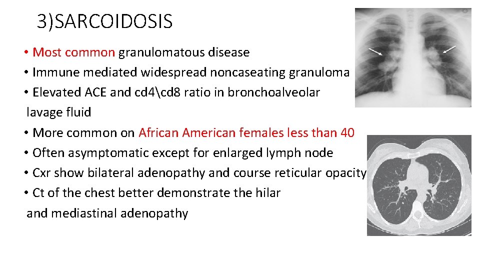 3)SARCOIDOSIS • Most common granulomatous disease • Immune mediated widespread noncaseating granuloma • Elevated