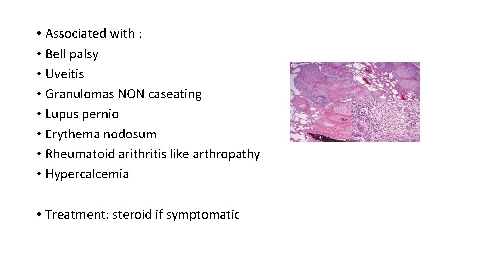  • Associated with : • Bell palsy • Uveitis • Granulomas NON caseating