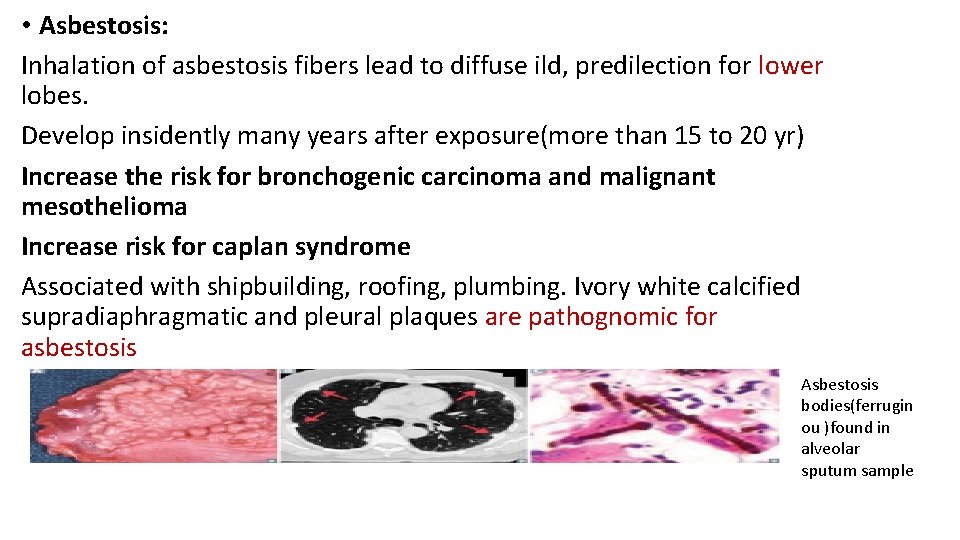  • Asbestosis: Inhalation of asbestosis fibers lead to diffuse ild, predilection for lower