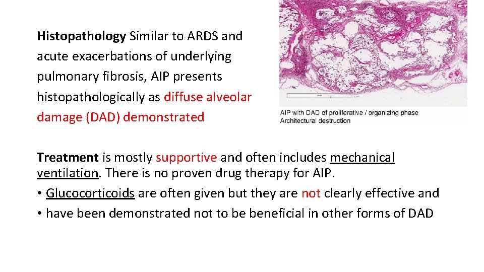 Histopathology Similar to ARDS and acute exacerbations of underlying pulmonary fibrosis, AIP presents histopathologically