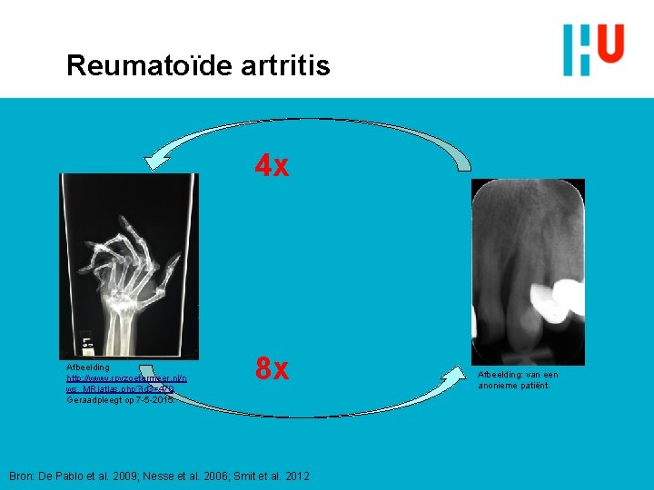 Reumatoïde artritis 4 x Afbeelding http: //www. rpvzoetermeer. nl/n ws_MRIatlas. php? id 3=470 Geraadpleegt