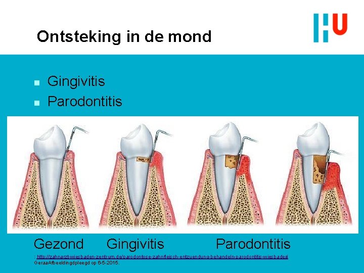 Ontsteking in de mond n n Gingivitis Parodontitis Gezond Gingivitis Parodontitis : http: //zahnarzt-wiesbaden-zentrum.
