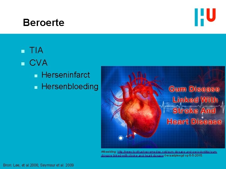 Beroerte n n TIA CVA n n Herseninfarct Hersenbloeding Afbeelding: http: //www. toothachesremedies. net/gum-disease-and-periodontitis/gumdisease-linked-with-stroke-and-heart-disease