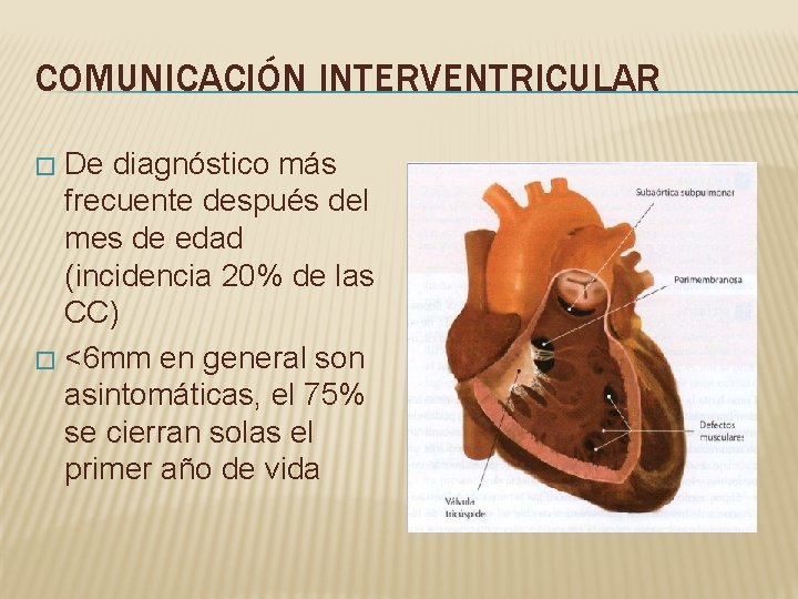 COMUNICACIÓN INTERVENTRICULAR De diagnóstico más frecuente después del mes de edad (incidencia 20% de COMUNICACIÓN INTERVENTRICULAR De diagnóstico más frecuente después del mes de edad (incidencia 20% de
