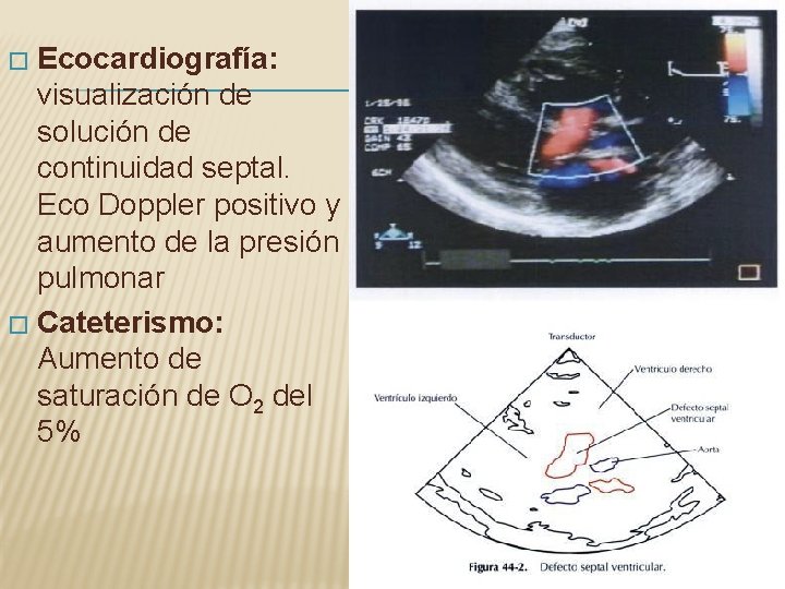 Ecocardiografía: visualización de solución de continuidad septal. Eco Doppler positivo y aumento de la