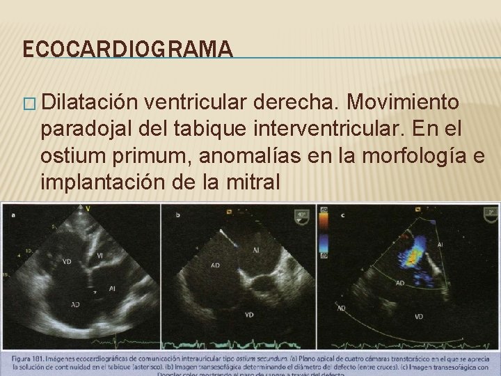 ECOCARDIOGRAMA � Dilatación ventricular derecha. Movimiento paradojal del tabique interventricular. En el ostium primum,