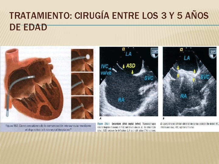 TRATAMIENTO: CIRUGÍA ENTRE LOS 3 Y 5 AÑOS DE EDAD 