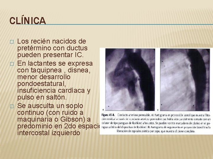 CLÍNICA � � � Los recién nacidos de pretérmino con ductus pueden presentar IC.