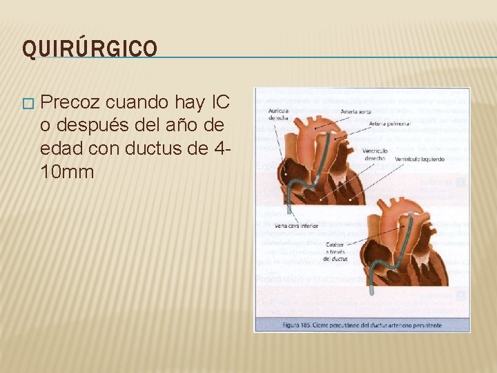 QUIRÚRGICO � Precoz cuando hay IC o después del año de edad con ductus