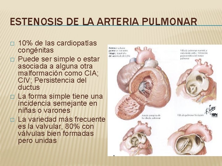 ESTENOSIS DE LA ARTERIA PULMONAR � � 10% de las cardiopatías congénitas Puede ser