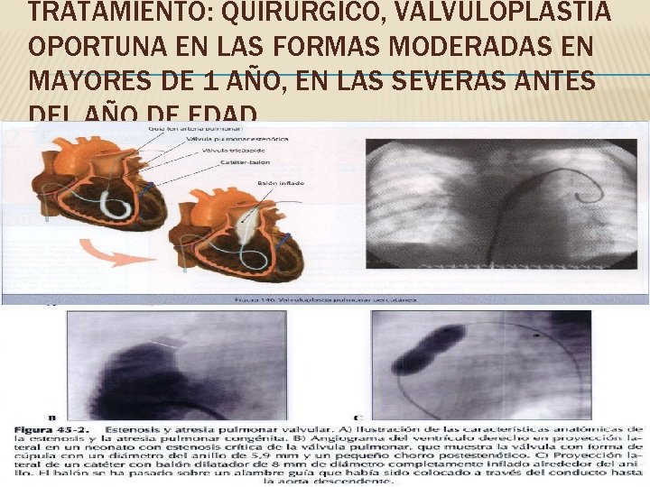 TRATAMIENTO: QUIRÚRGICO, VALVULOPLASTIA OPORTUNA EN LAS FORMAS MODERADAS EN MAYORES DE 1 AÑO, EN