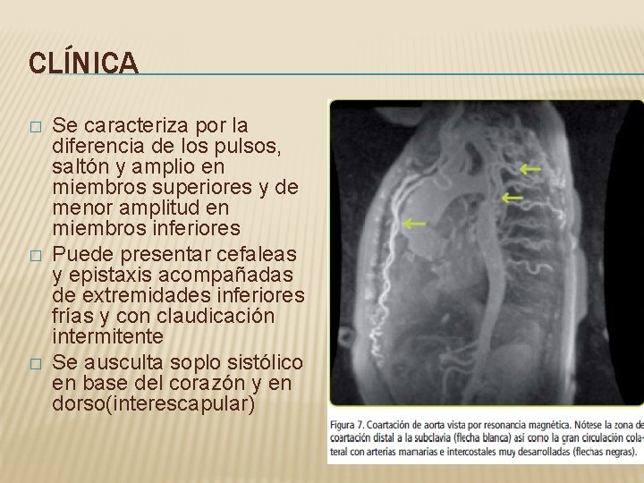 CLÍNICA � � � Se caracteriza por la diferencia de los pulsos, saltón y CLÍNICA � � � Se caracteriza por la diferencia de los pulsos, saltón y