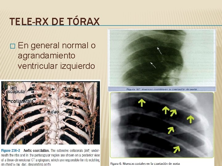 TELE-RX DE TÓRAX � En general normal o agrandamiento ventricular izquierdo TELE-RX DE TÓRAX � En general normal o agrandamiento ventricular izquierdo