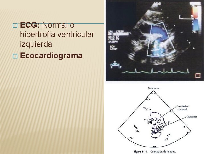 ECG: Normal o hipertrofia ventricular izquierda � Ecocardiograma � ECG: Normal o hipertrofia ventricular izquierda � Ecocardiograma �