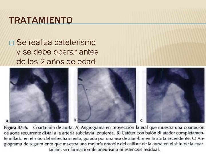 TRATAMIENTO � Se realiza cateterismo y se debe operar antes de los 2 años