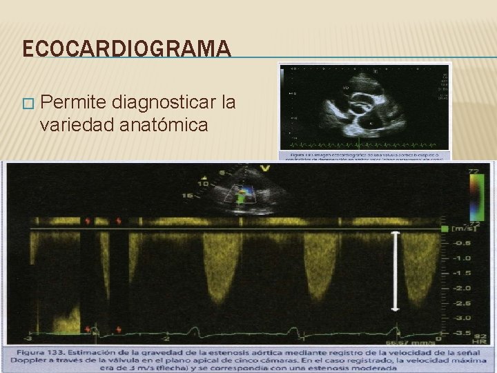 ECOCARDIOGRAMA � Permite diagnosticar la variedad anatómica 