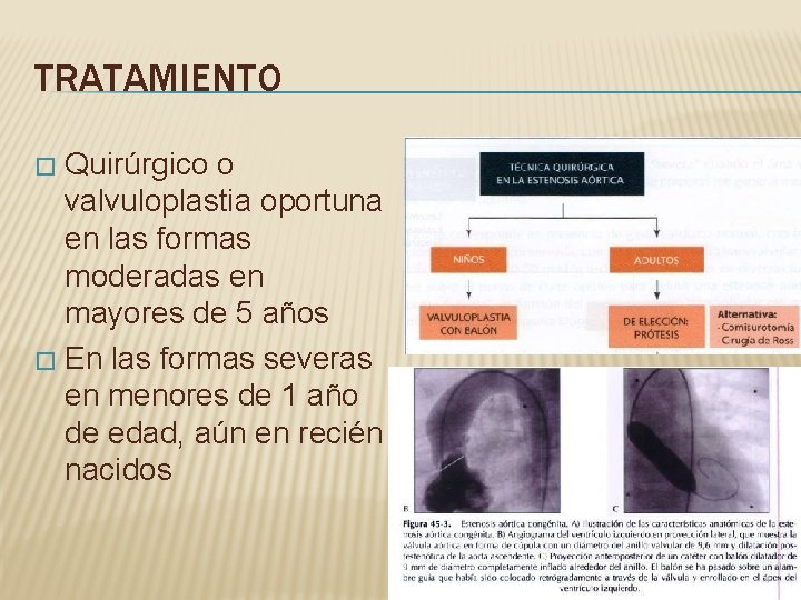 TRATAMIENTO Quirúrgico o valvuloplastia oportuna en las formas moderadas en mayores de 5 años