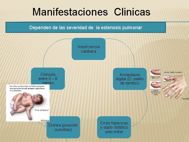 Manifestaciones Clinicas Dependen de las severidad de la estenosis pulmonar Insuficiencia cardiaca Cianosis entre