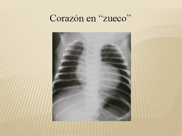 Corazón en “zueco” 