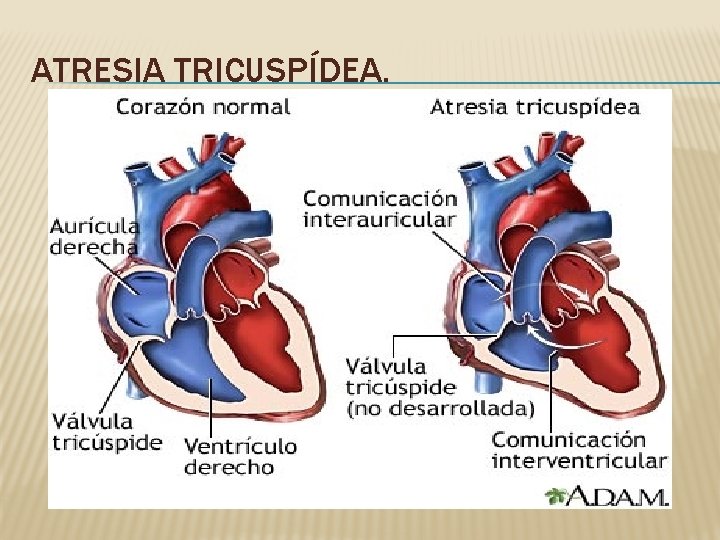 ATRESIA TRICUSPÍDEA. 