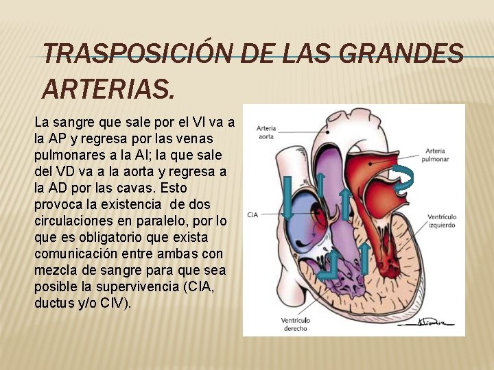 TRASPOSICIÓN DE LAS GRANDES ARTERIAS. La sangre que sale por el VI va a