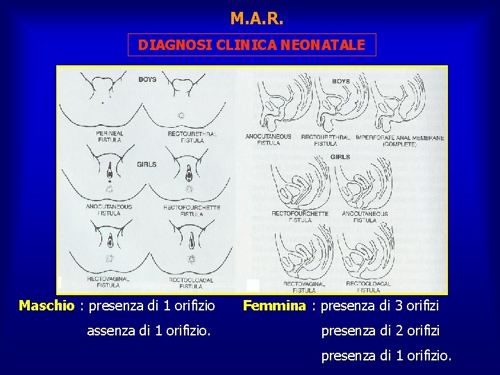 M. A. R. DIAGNOSI CLINICA NEONATALE Maschio : presenza di 1 orifizio Femmina :