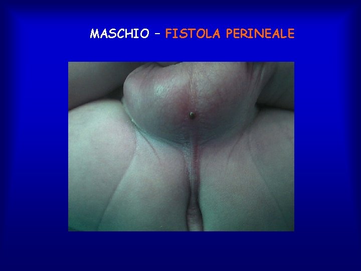 MASCHIO – FISTOLA PERINEALE 