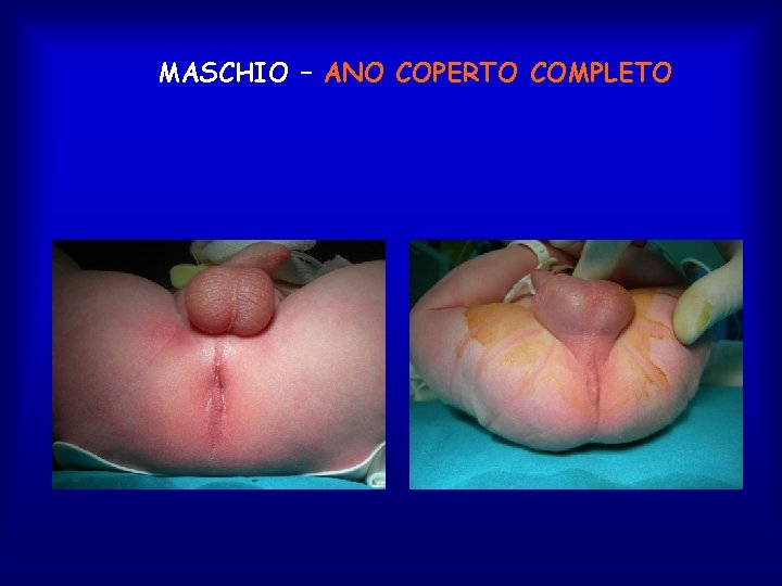 MASCHIO – ANO COPERTO COMPLETO 