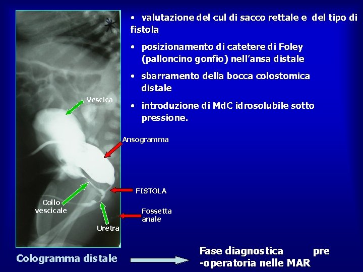  • valutazione del cul di sacco rettale e del tipo di fistola •