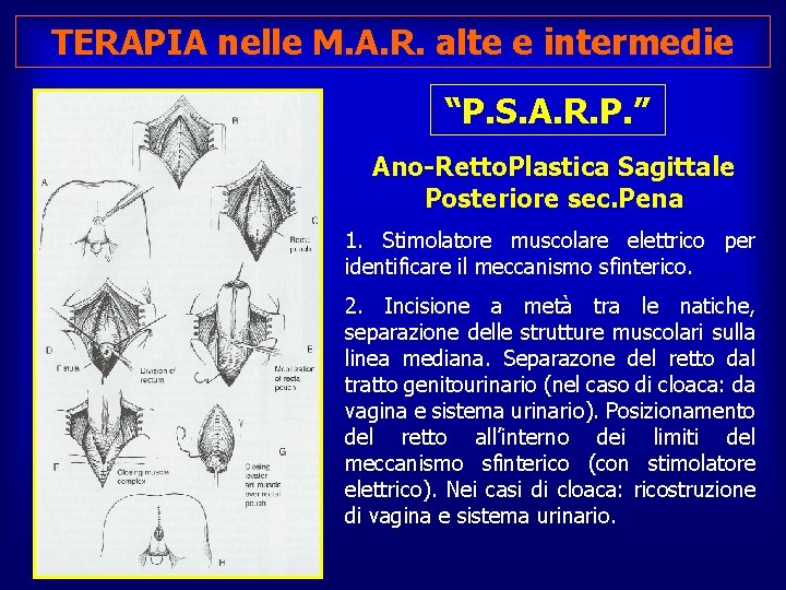 TERAPIA nelle M. A. R. alte e intermedie “P. S. A. R. P. ”