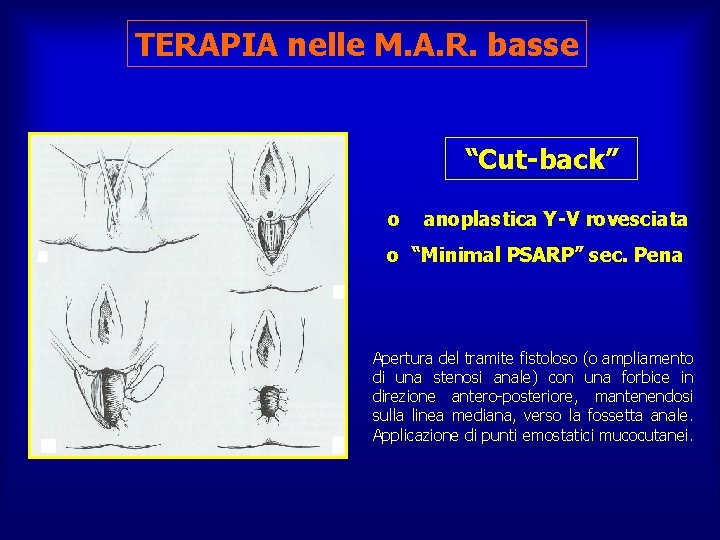 TERAPIA nelle M. A. R. basse “Cut-back” o anoplastica Y-V rovesciata o “Minimal PSARP”