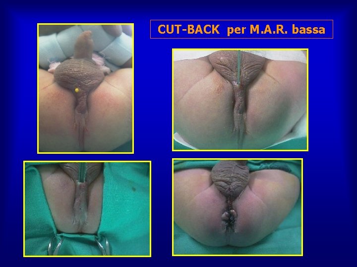 CUT-BACK per M. A. R. bassa 