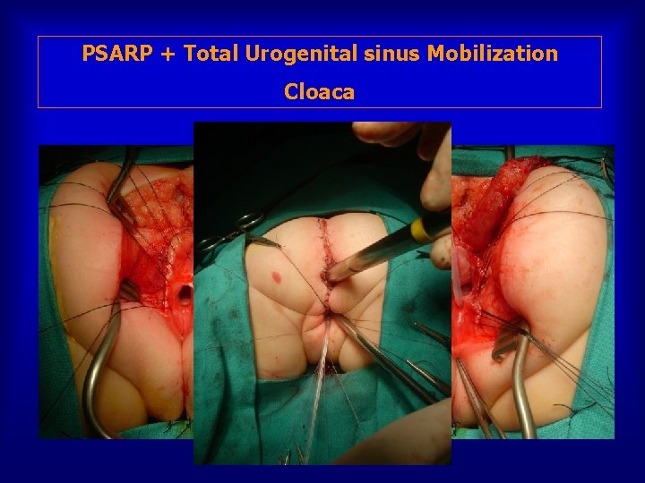 PSARP + Total Urogenital sinus Mobilization Cloaca 