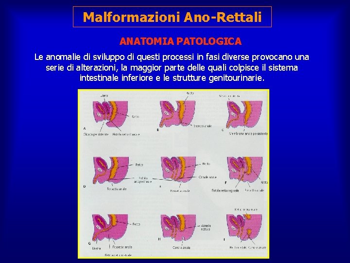 Malformazioni Ano-Rettali ANATOMIA PATOLOGICA Le anomalie di sviluppo di questi processi in fasi diverse