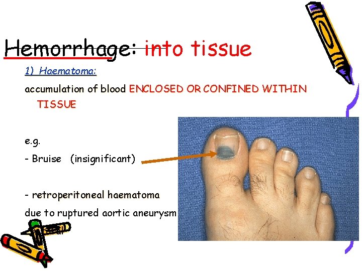 Hemorrhage: into tissue 1) Haematoma: accumulation of blood ENCLOSED OR CONFINED WITHIN TISSUE e.