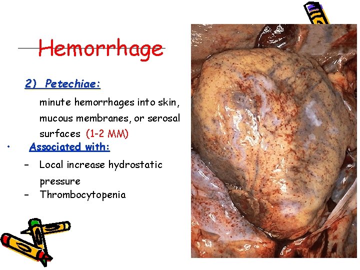 Hemorrhage 2) Petechiae: minute hemorrhages into skin, mucous membranes, or serosal • surfaces (1