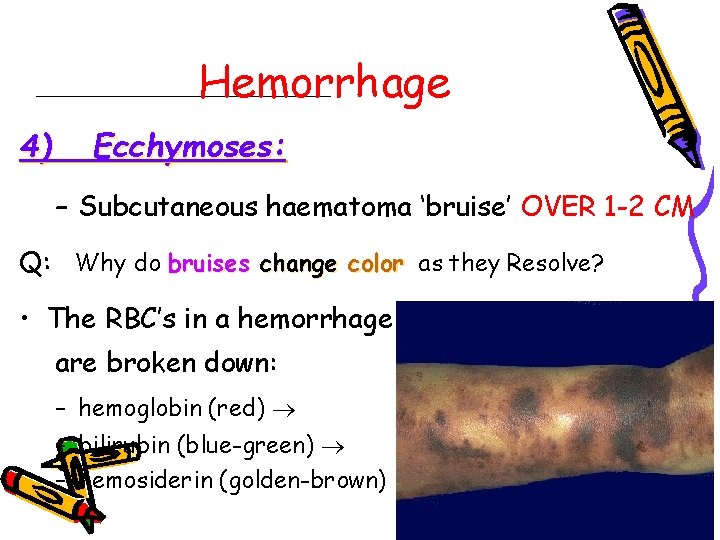 Hemorrhage 4) Ecchymoses: – Subcutaneous haematoma ‘bruise’ OVER 1 -2 CM Q: Why do