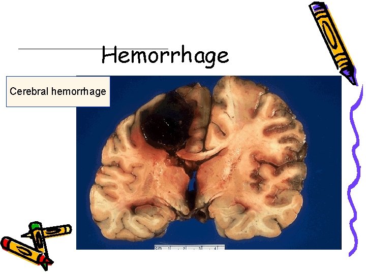 Hemorrhage Cerebral hemorrhage 