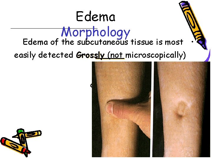 Edema Morphology Edema of the subcutaneous tissue is most • easily detected Grossly (not