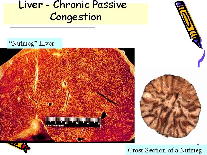 Liver - Chronic Passive Congestion “Nutmeg” Liver Cross Section of a Nutmeg 