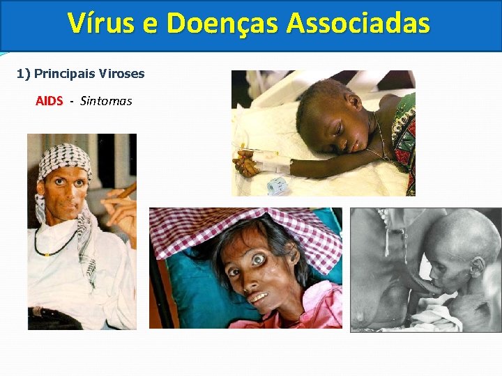 Vírus e Doenças Associadas 1) Principais Viroses AIDS - Sintomas 