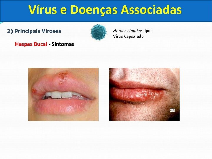 Vírus e Doenças Associadas 2) Principais Viroses Hespes Bucal - Sintomas Herpes simplex tipo