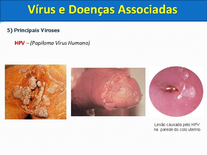 Vírus e Doenças Associadas 5) Principais Viroses HPV – (Papiloma Vírus Humano) Lesão causada