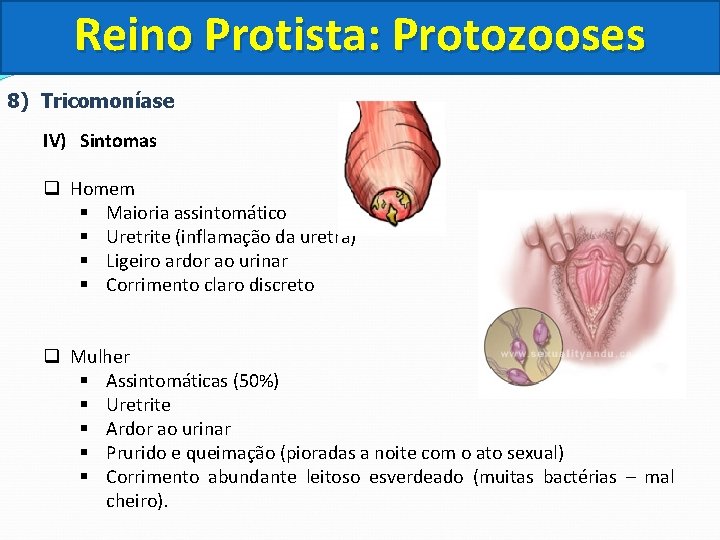 Reino Protista: Protozooses 8) Tricomoníase IV) Sintomas q Homem Maioria assintomático Uretrite (inflamação da