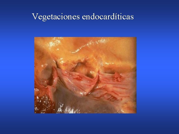 Vegetaciones endocardíticas 