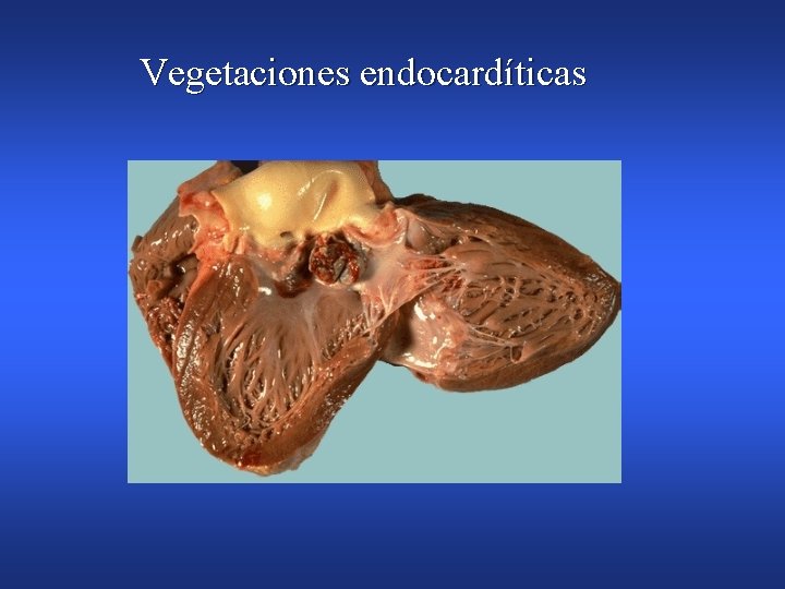 Vegetaciones endocardíticas 