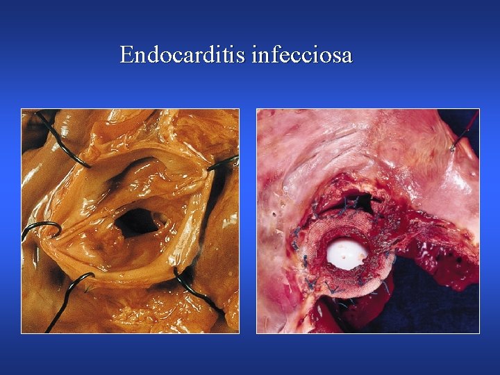 Endocarditis infecciosa 