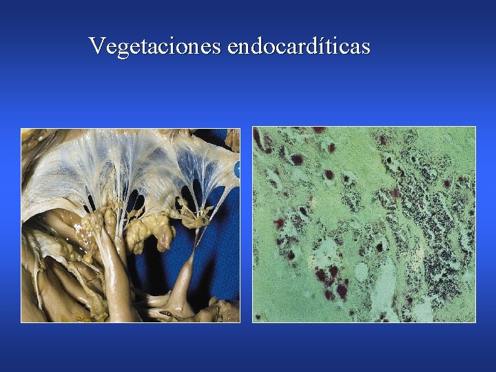 Vegetaciones endocardíticas 